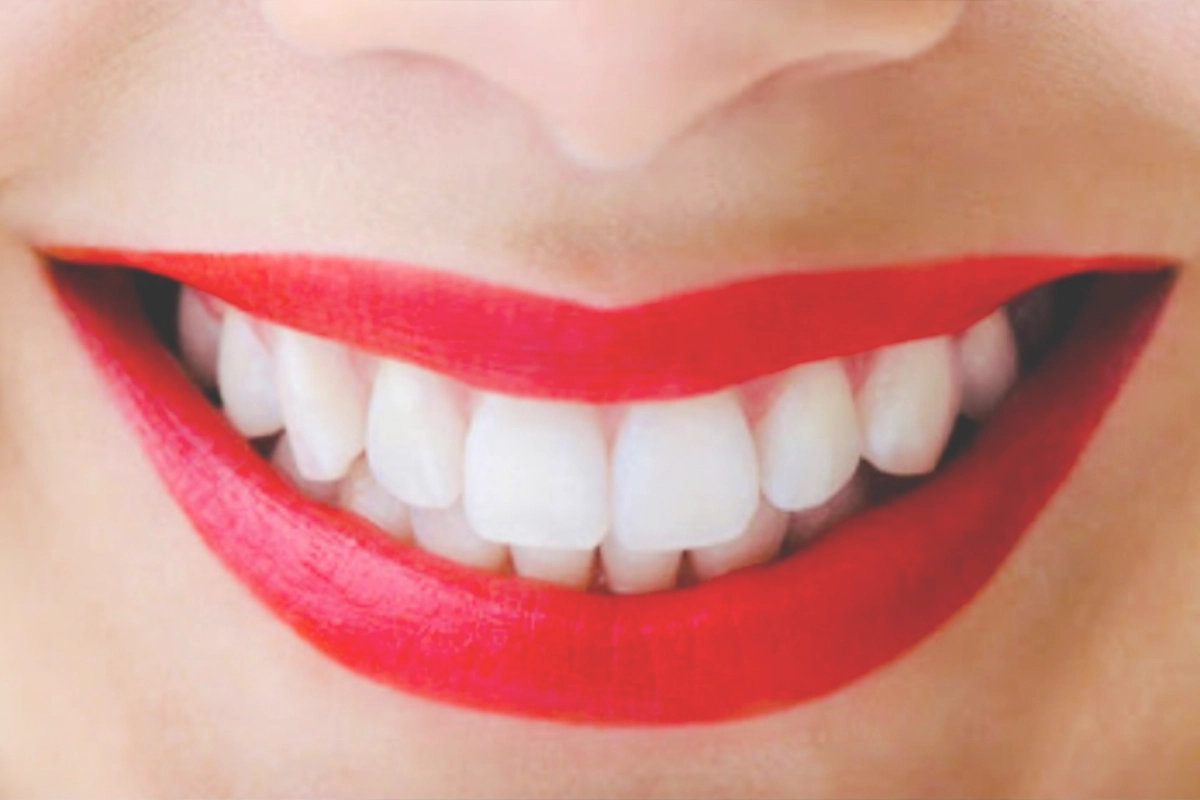 10. Professional Teeth Whitening (2)