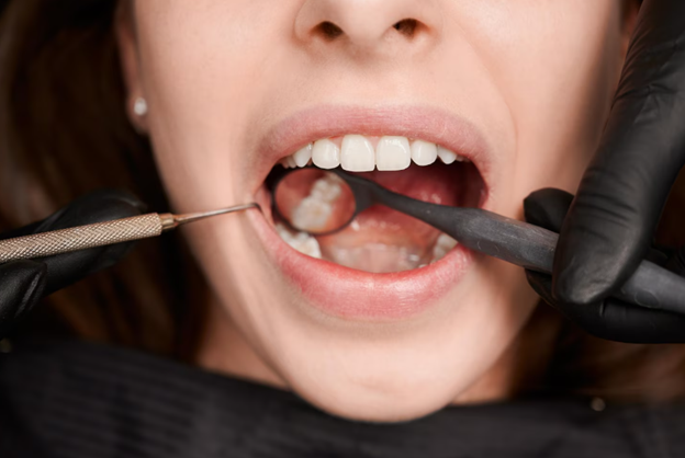 Root Canal in Ottawa